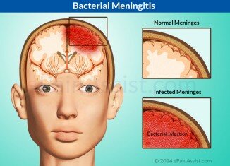 Ciri-Ciri Dan Gejala Meningitis