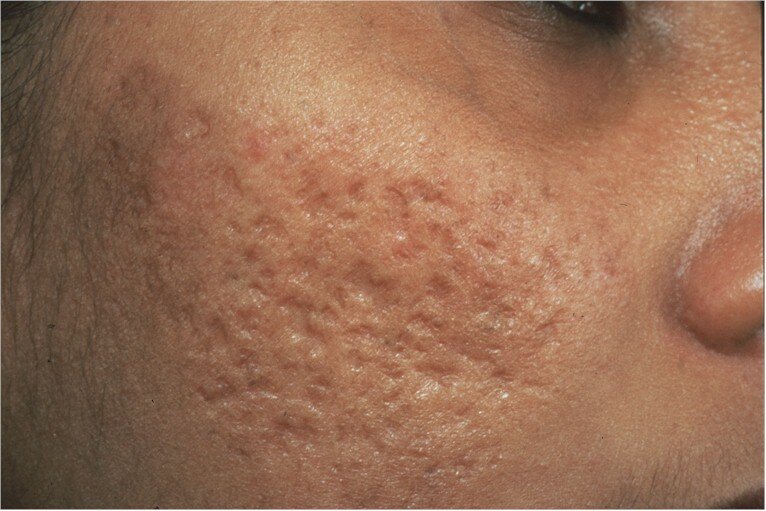 acne_scars1
